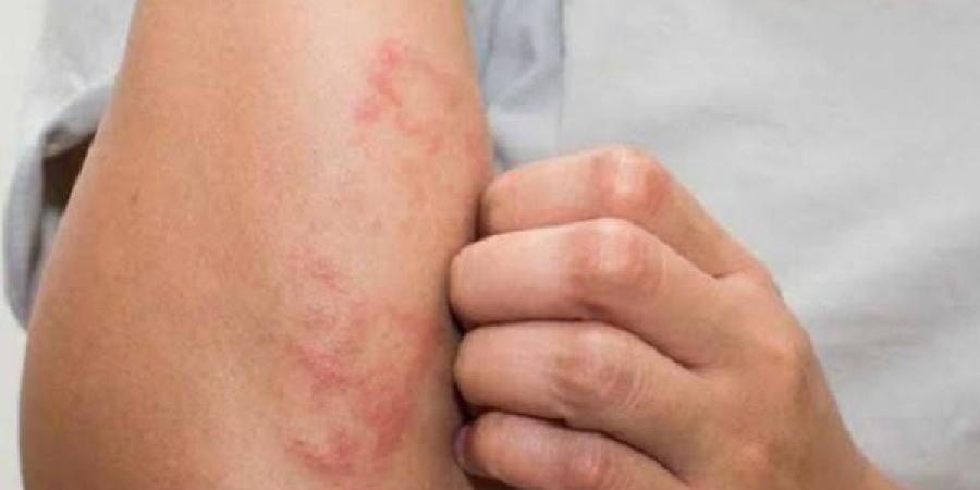 أبرز الأمراض الجلدية المرتبطة بفصل الصيف - بوابة اخر ساعة